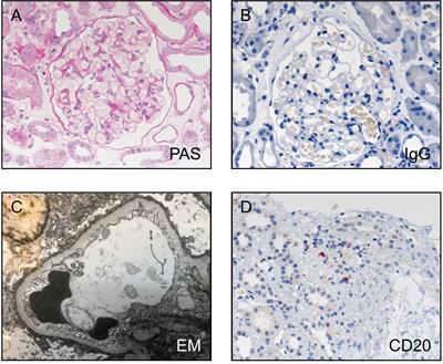 Rituximab Induces Complete Remission of Proteinuria in a Patient With Minimal Change Disease and No Detectable B Cells